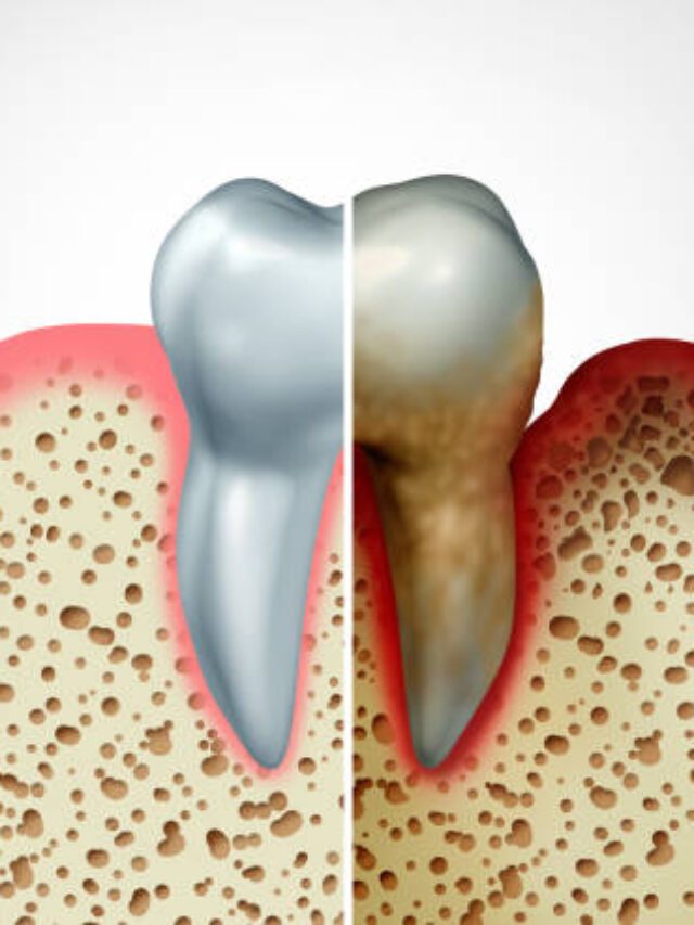 Types of Gum Disease Symptoms and Treatment Options